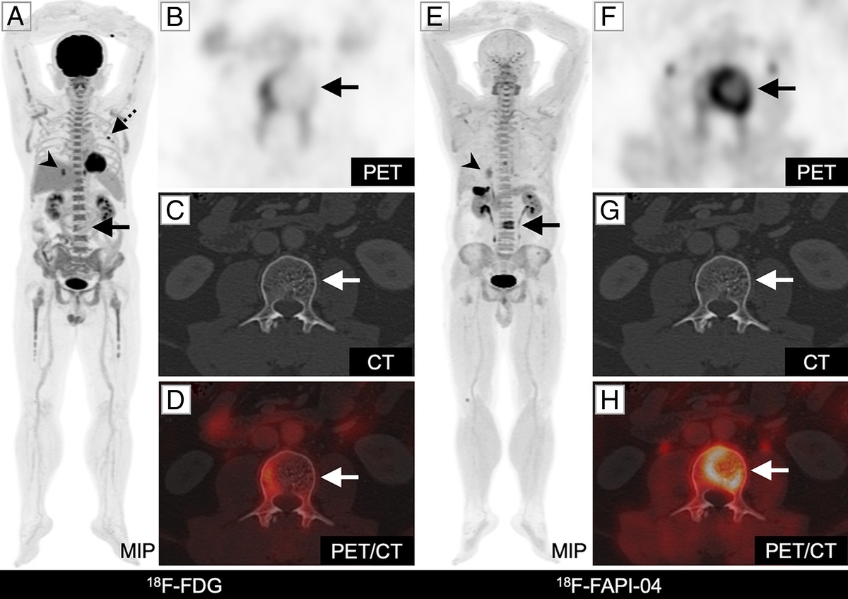 Increased 18F-FAPI-04 Uptake in Vertebral Hemangioma