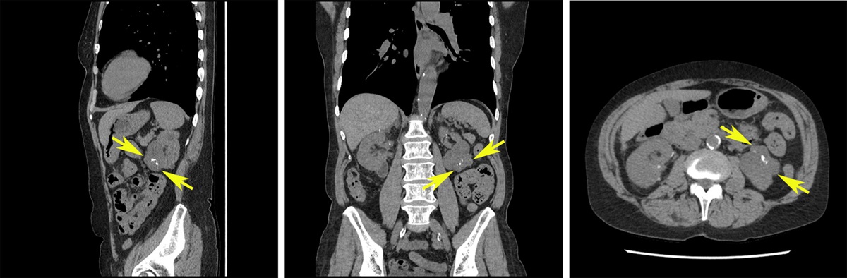 Multicystic Clear Cell Renal Tumors With Low-grade Nuclear Features: Time to Include TFE3 Translocation-associated Carcinomas
