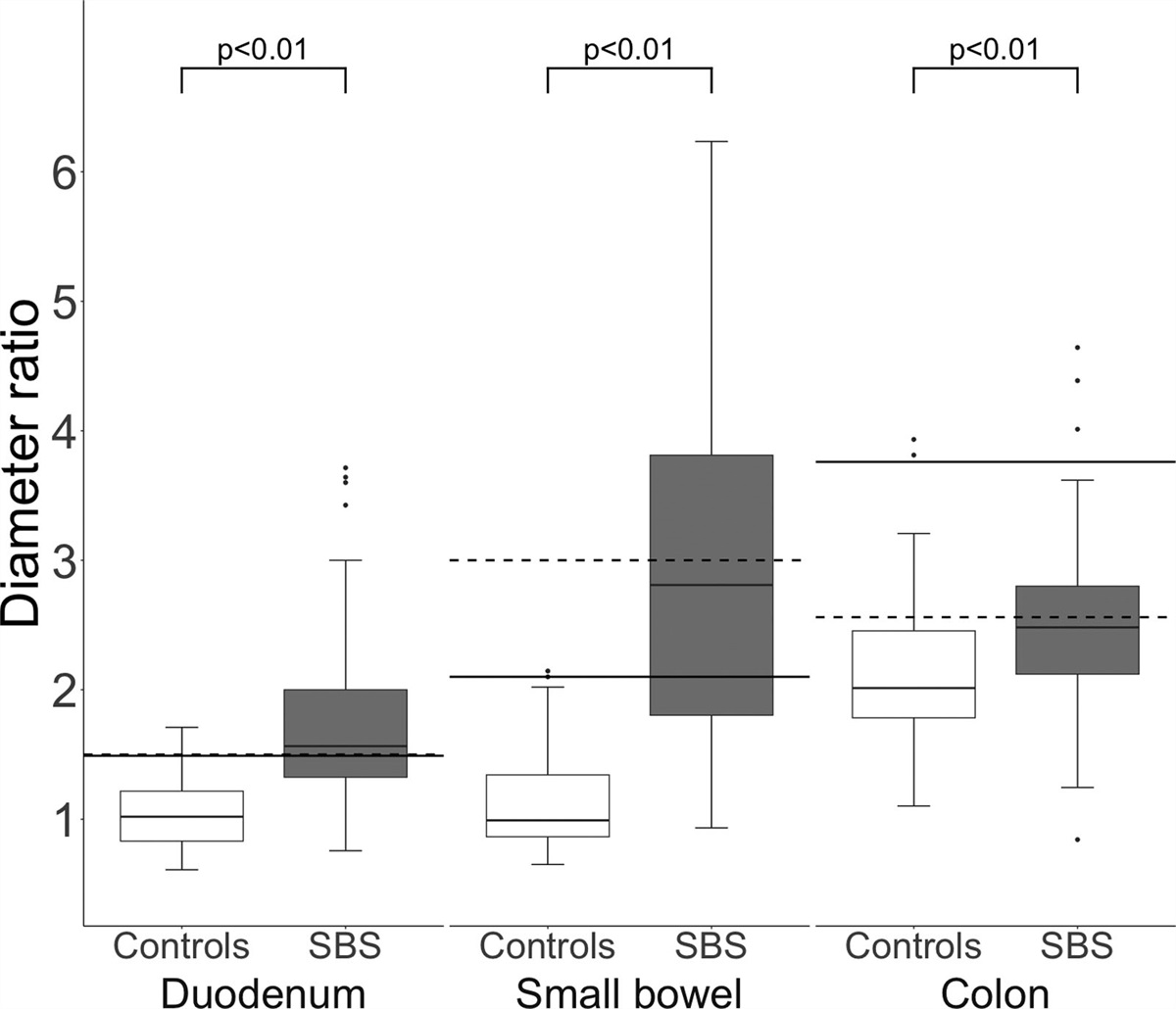 Cutoffs and Characteristics of Abnormal Bowel Dilatation in Pediatric Short Bowel Syndrome