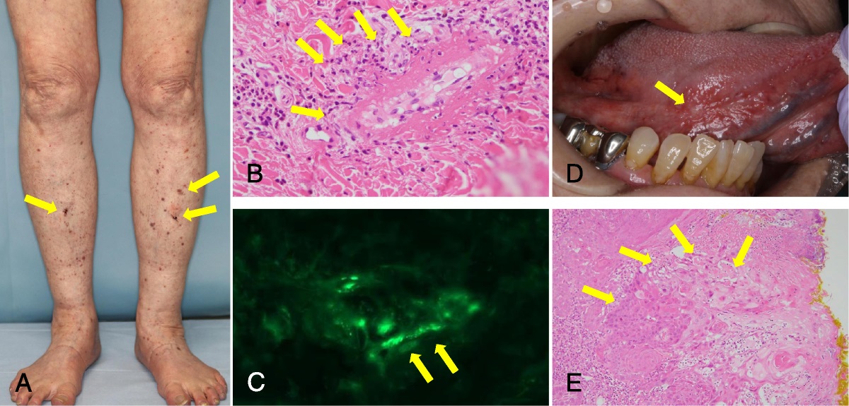 Immunoglobulin A Vasculitis as a Sign of Recurrence of Lingual Cancer
