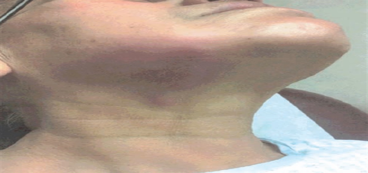An unrelenting rash