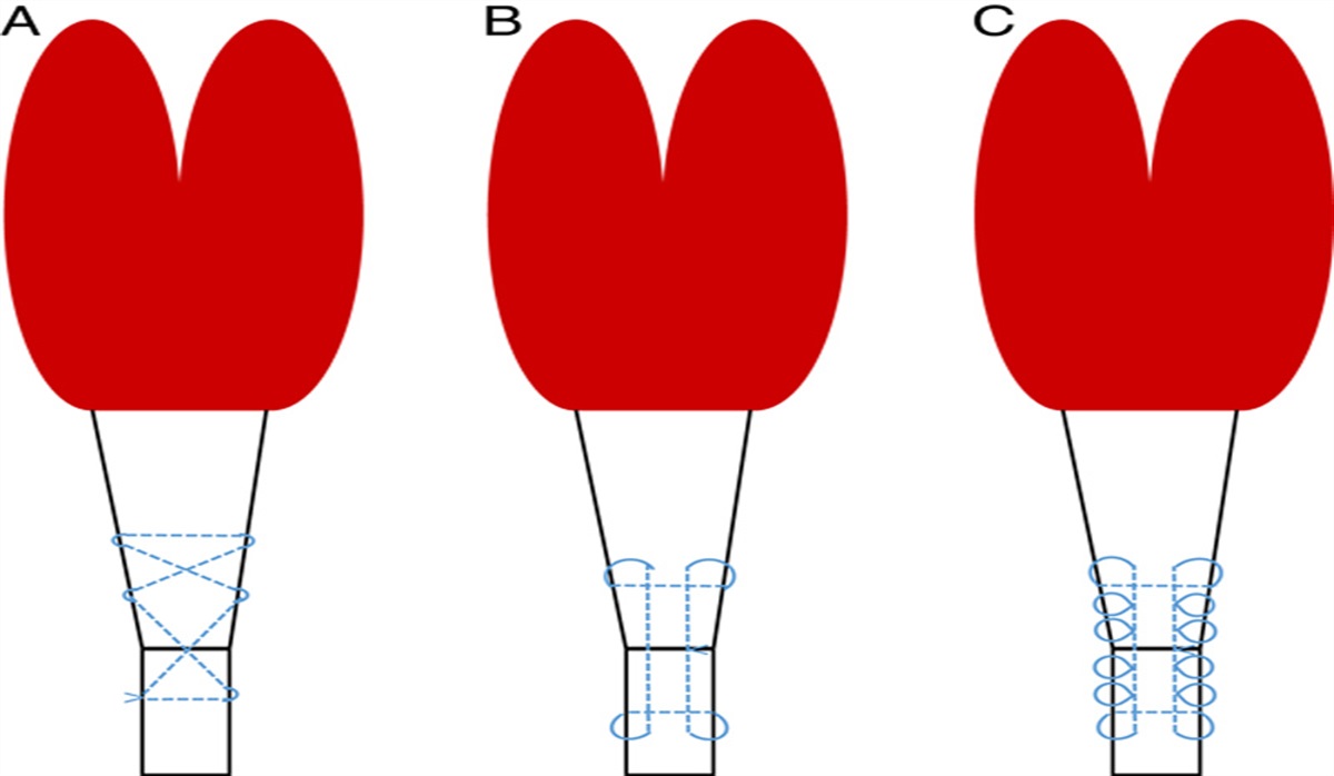 Traditional Open Repair and Reconstruction of Achilles Tendon Rupture