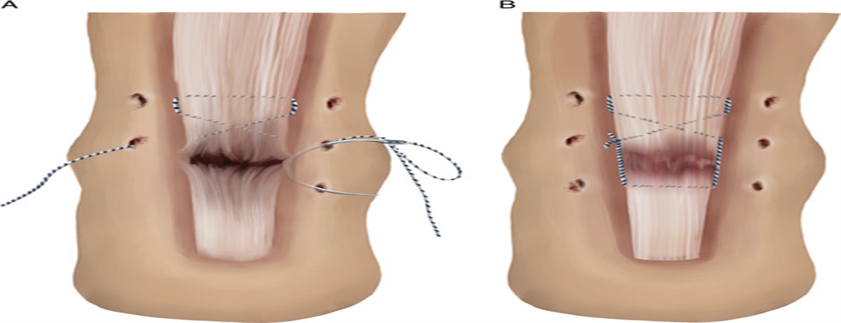 Achilles Tendon Ruptures: Limited Incision Repair