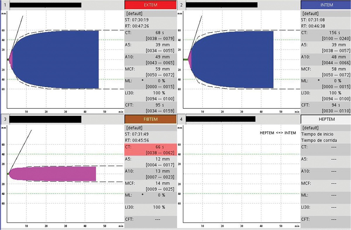 Tranexamic Acid in Cardiac Surgery: A Case Report of an Infrequent Adverse Reaction to a Common Medication.
