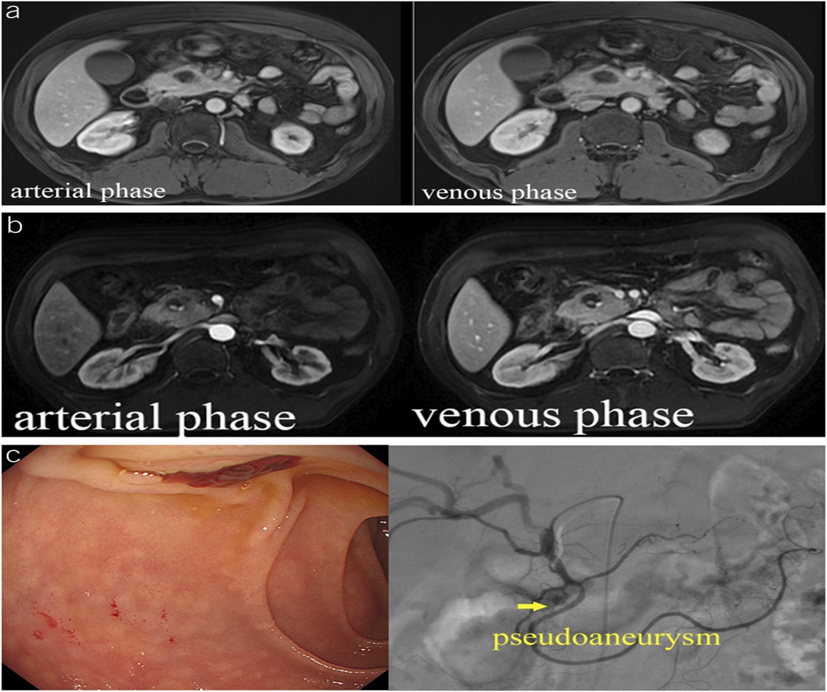 An Unusual Case of Hemosuccus Pancreaticus Mimicking Pancreatic Neoplasm